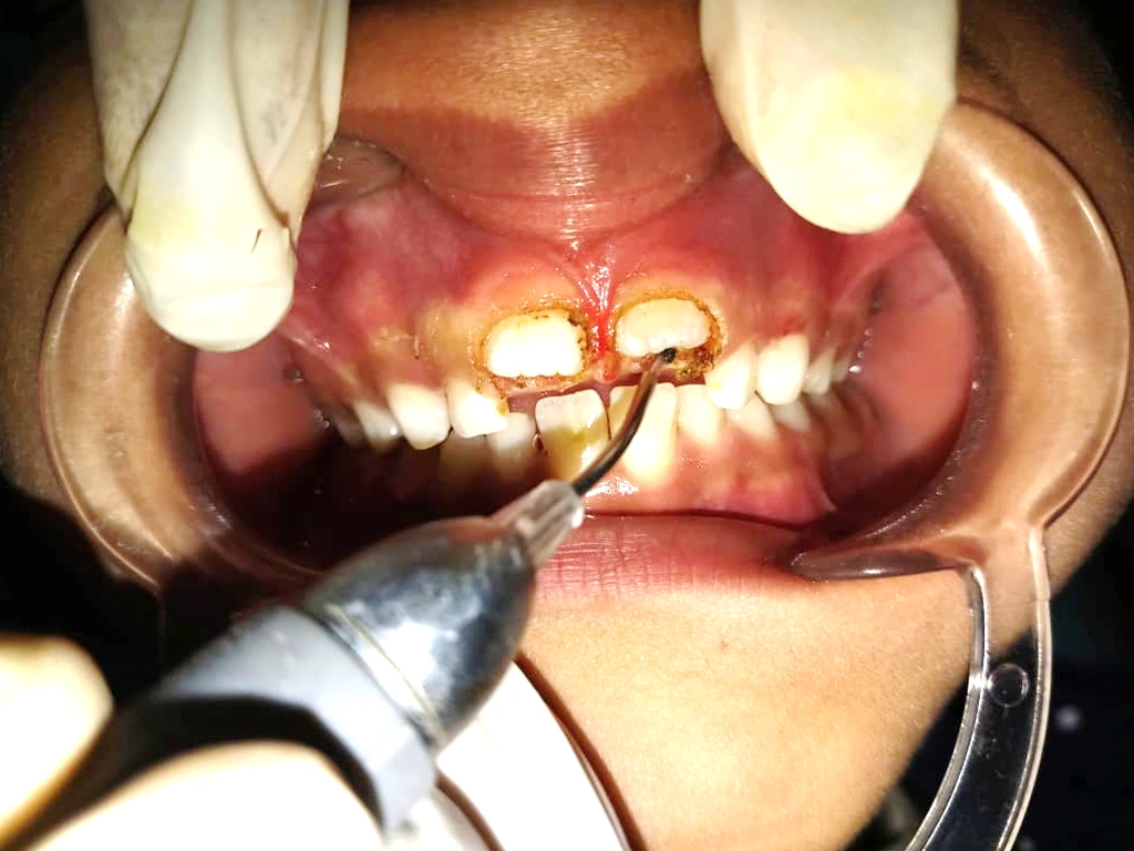 Laser Dentistry