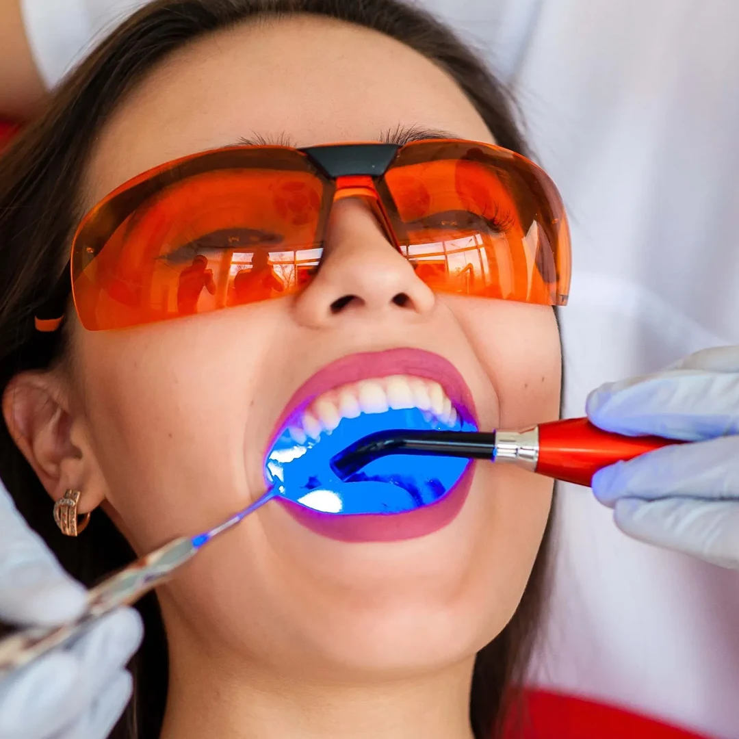 Laser Teeth Whitening in Delhi – Get a Dazzling Smile at Topazdent Dental Care