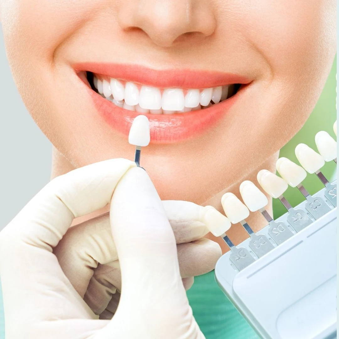 Teeth Whitening / Teeth Bleaching: A Brighter, Confident Smile at Topazdent Dental Care