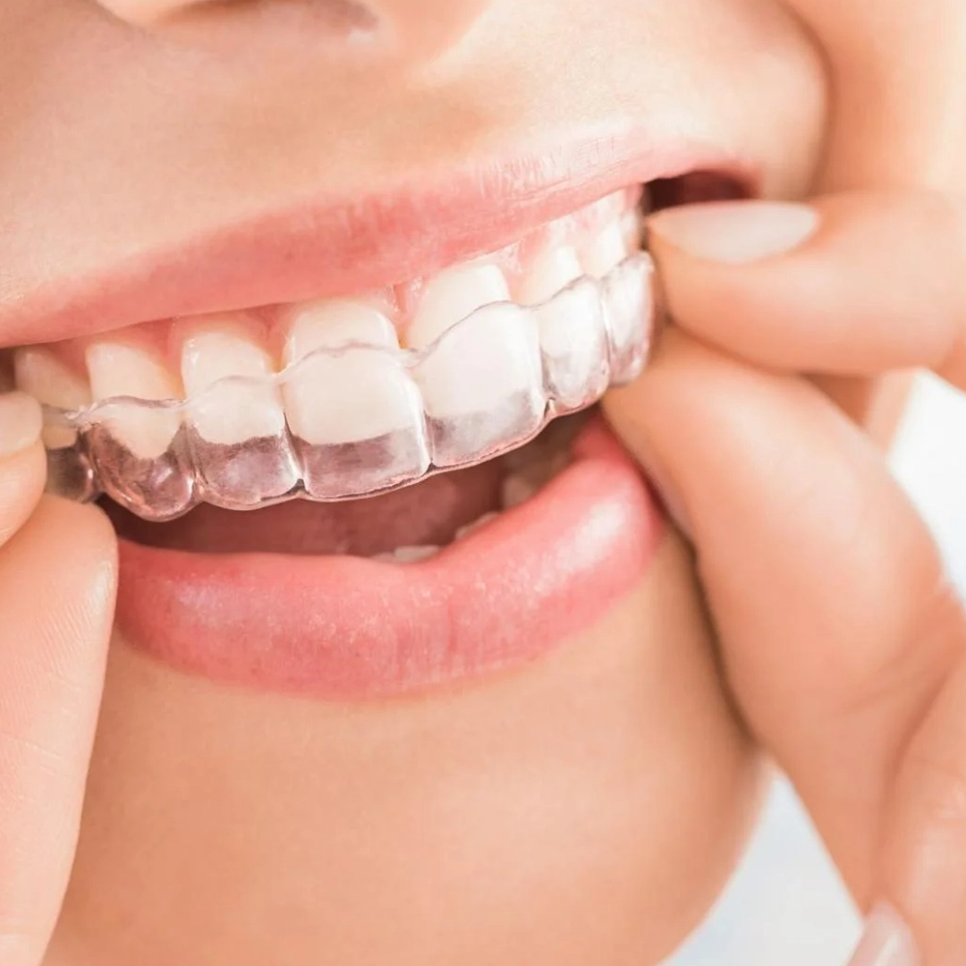 Clear aligners / Transparent Braces for Teeth: A Modern way to straighten your smile at Topazdent Dental Care, Delhi