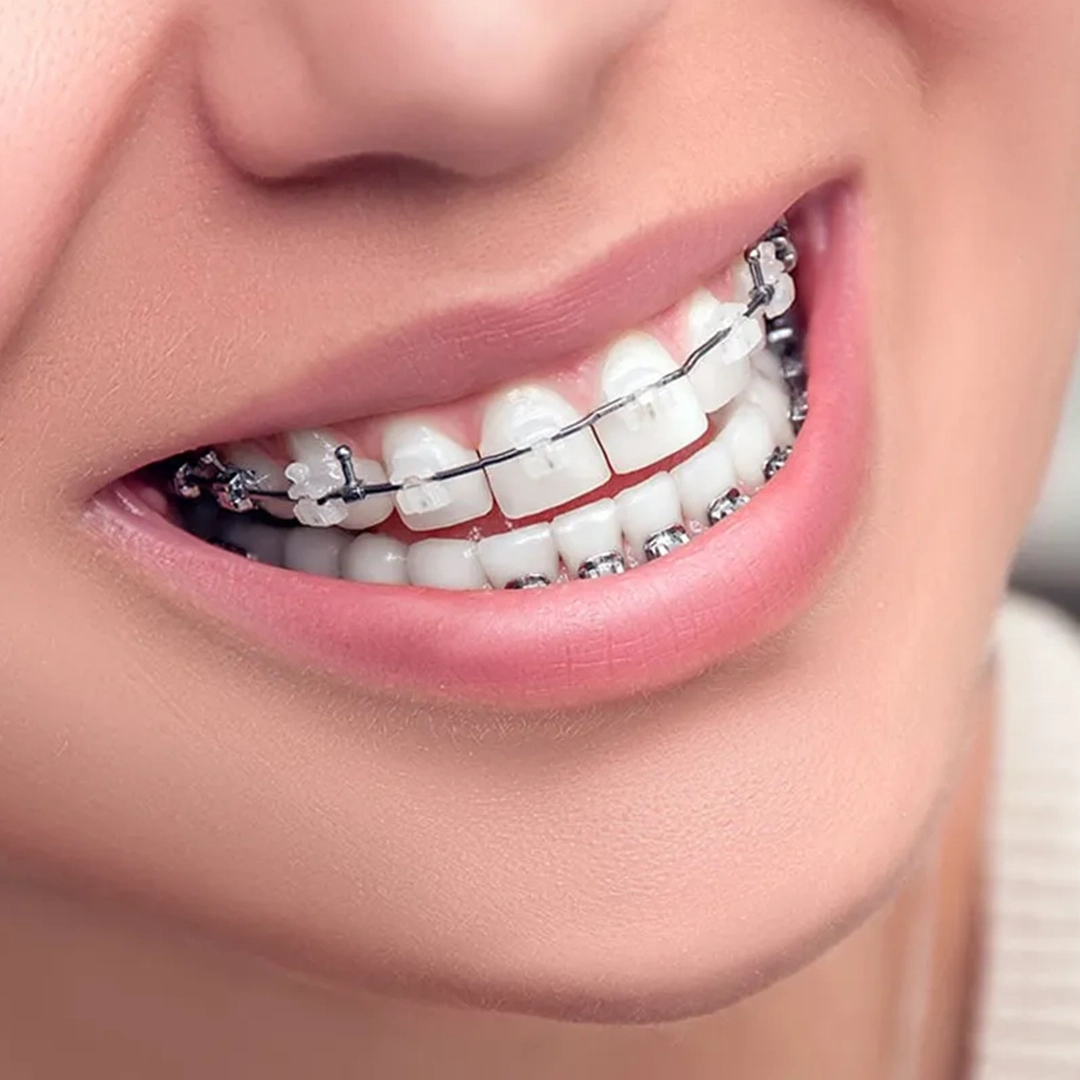 Invisible Aligners:Straighter Teeth the Smart & Invisible Way | Topazdent Dental Care